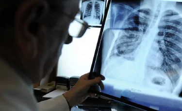 В Казахстане за прошедшие сутки 4 человека скончались от пневмонии