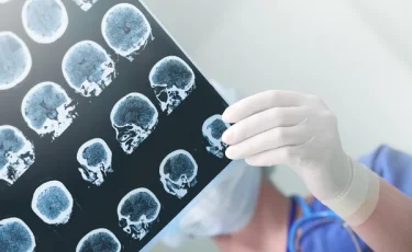 В Казахстане снижается смертность от инсультов
